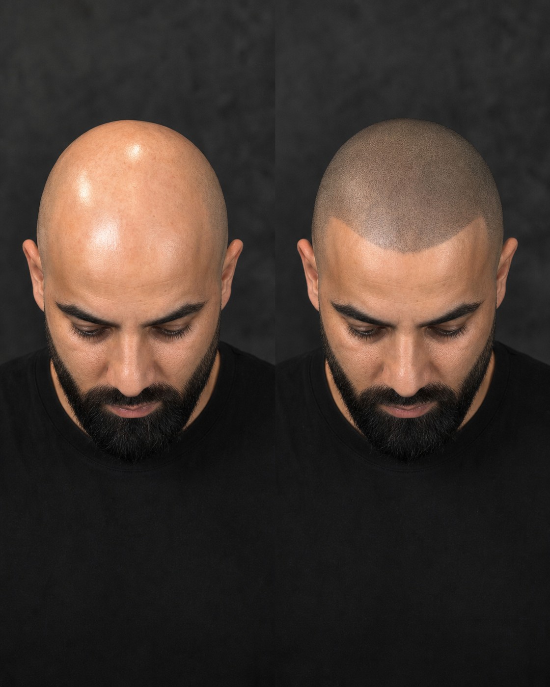 Before and after scalp micropigmentation — case 7