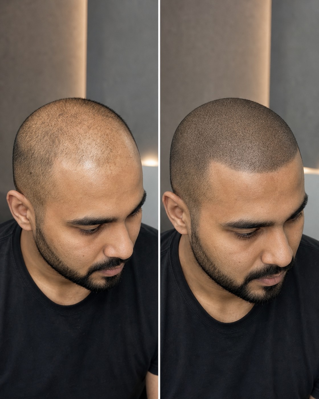Before and after scalp micropigmentation — case 8